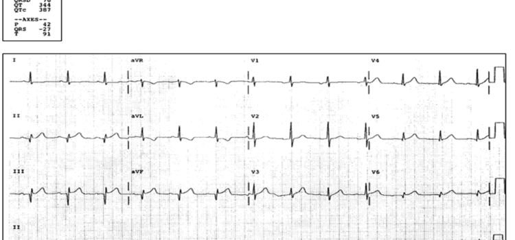 A 65-Year-Old Man with Epigastric Pain, Dyspnea, and a ‘Clammy’ Feeling