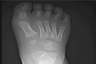 A 2-Year-Old with Foot Pain After Jumping Off a Bed