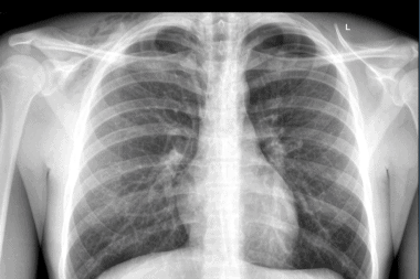 An 18-Year-Old Male with Shortness of Breath and ‘Tightness’ in His Chest