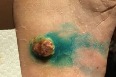 Kaposi Sarcoma Presenting in the Urgent Care Setting as a Single Mass Lesion of the Foot