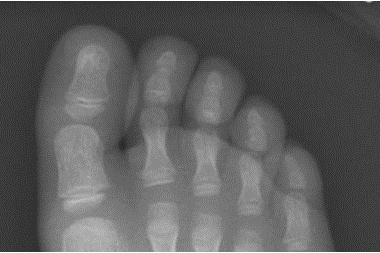 A 6-Year-Old Boy with Foot Pain After Tripping a Day Earlier