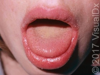 An 8-Year-Old Girl with Persistent Sore Throat and Fever