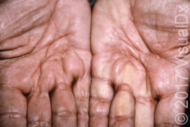 A 70-Year-Old Man with Hand Numbness and Pain