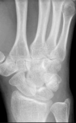 A 42-Year-Old Female with Pain After a Child Fell on Her Hand