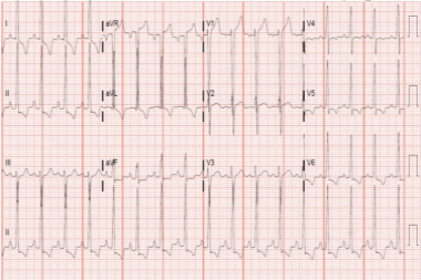 A 69-Year-Old Man with a 2-Month History of Shortness of Breath and Mild Chest Pain