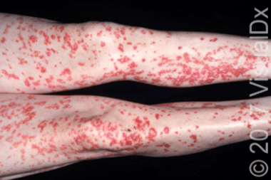 A 42-Year-Old Male with a New Symmetrical Rash on His Legs