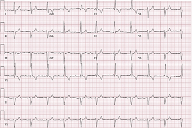 A 58-Year-Old Female with Syncope