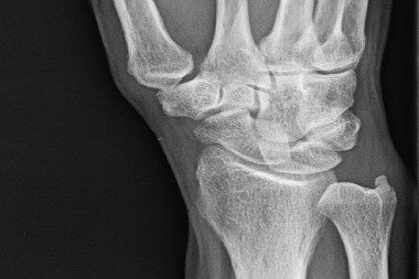 A 53-Year-Old Male with Wrist Pain After a Fall