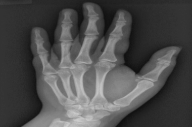 A 17-Year-Old Male with Pain and Swelling in His Thumb