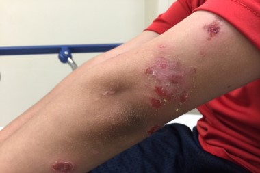 A Blistering Rash in an Otherwise Healthy 9-Year-Old Boy