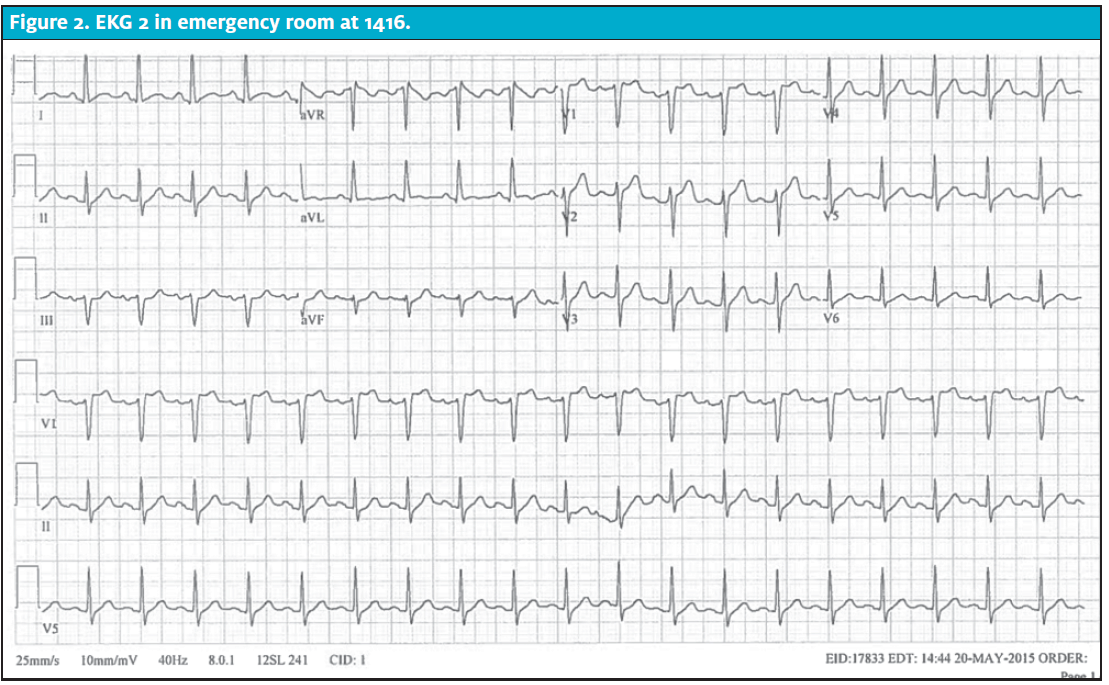 cardiac monitor that contiusly monity st elevation cardiac monitor that contiusly monity st elevation