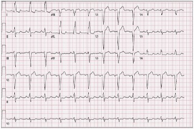 A 54-Year-Old Female with Nonproductive Cough and Rhinorrhea