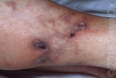 A 72-Year-Old Female with Lesions on Her Lower Legs