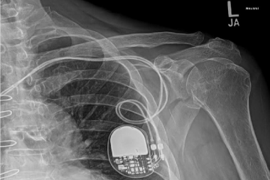 A 90-Year-Old Male with Shoulder Pain After a Fall
