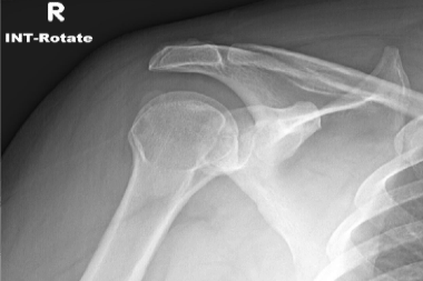 A 38-Year-Old Man with an Exacerbation of Shoulder Pain