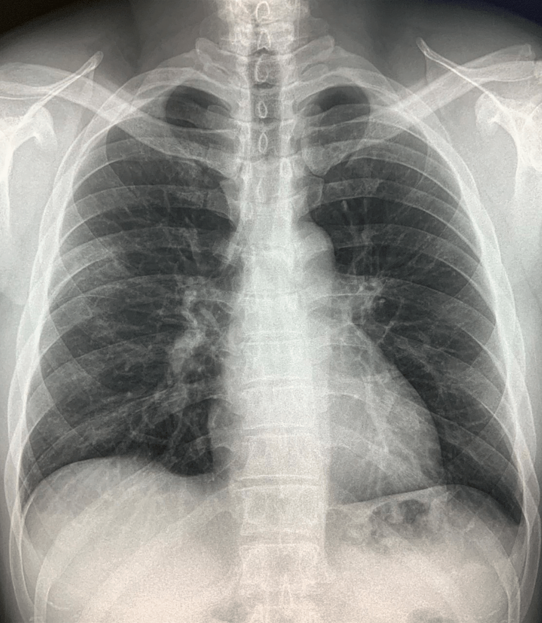 Chest X-Ray Findings in 636 Ambulatory Patients with COVID-19 ...