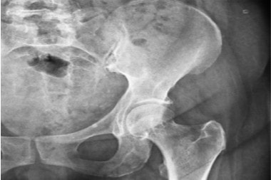 A 55-Year-Old Female with Hip Pain