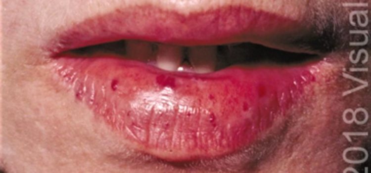 A 22-Year-Old Female with Frequent Nosebleeds and Abnormalities on Her Lips and Tongue