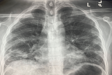 Chest X-Ray Findings in 636 Ambulatory Patients with COVID-19 Presenting to an Urgent Care Center: A Normal Chest X-Ray Is no Guarantee