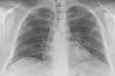 A 40-Year-Old Man with Cough and Fever During the COVID-19 Pandemic