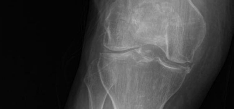 A 47-Year-Old Male with Knee Pain and Swelling After a Fall