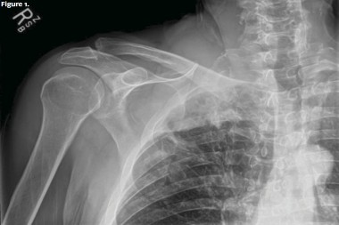 A 67-Year-Old Male with Shoulder and Neck Pain