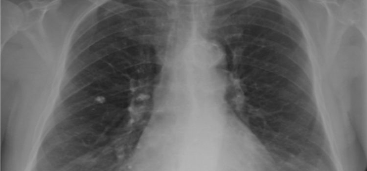 A 28-Year-Old Male with a Persistent Dry Cough