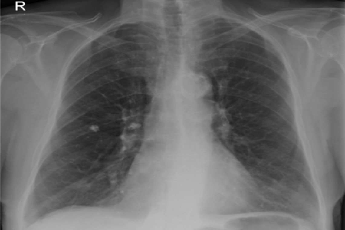 Persistent Dry Rattling Cough at Michelle Almazan blog