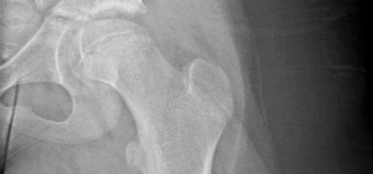 A 9-Year-Old Girl with Hip Pain After Taking a Fall
