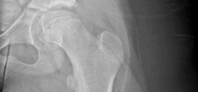 A 9-Year-Old Girl with Hip Pain After Taking a Fall