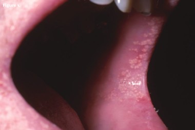 A 24-Year-Old Male with Papules in His Mouth