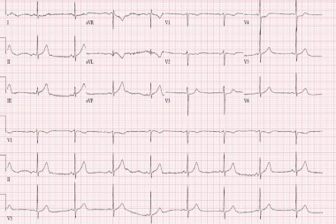 A 67-Year-Old Male with Classic Signs of Myocardial Infarction