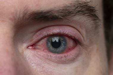 Look into the Patient’s Eyes—They May Hold Additional Clues to Their COVID-19 Status