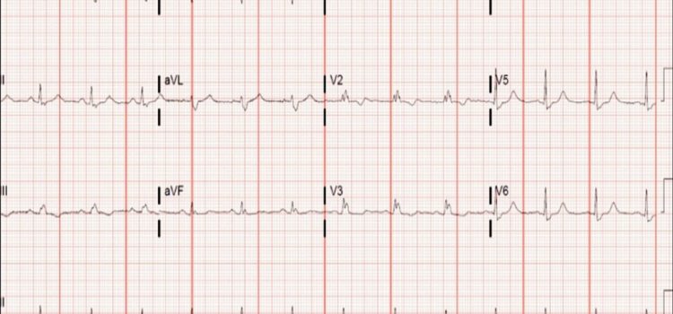 A 42-Year-Old Male with an Abnormal ECG