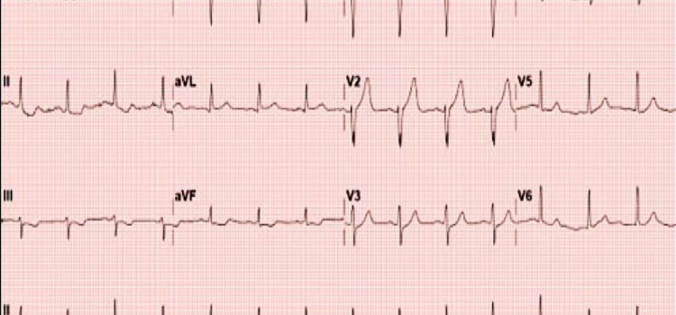 Chest Pain in a 44-Year-Old Male: Is It Too Early for Emergent Coronary Intervention?