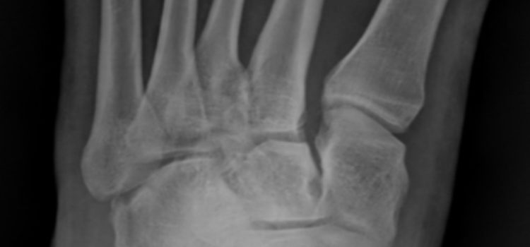 A 28-Year-Old Woman with Foot Pain After a 10-Foot-Fall A 28-Year-Old Woman with Foot Pain After a 10-Foot-Fall