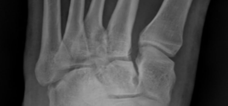 A 28-Year-Old Woman with Foot Pain After a 10-Foot-Fall