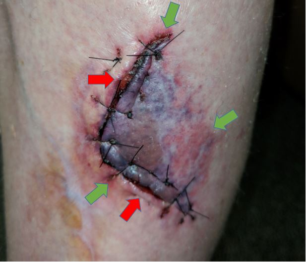 How to Identify and Repair a Laceration Like a Professional