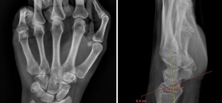 A 46-Year-Old Woman with Wrist Pain After Hearing a ‘Snap’