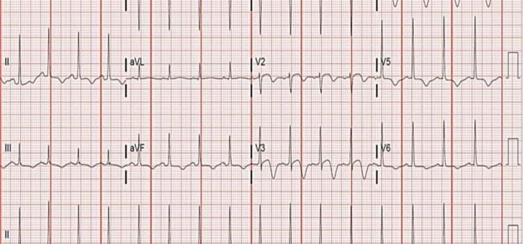 A 60-Year-Old Woman with a 4-Day History of Intermittent Exertional Chest Pain