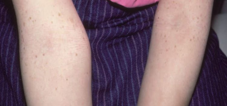 An 8-Year-Old Girl with Lesions on Her Arms