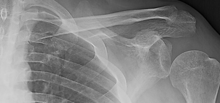 A 35-Year-Old Man with Shoulder Pain Weeks After a Car Accident