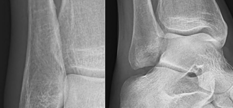 A 45-Year-Old Female Runner with Lower Extremity Pain