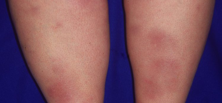 A 33-Year-Old Woman with Blanching on Her Lower Legs