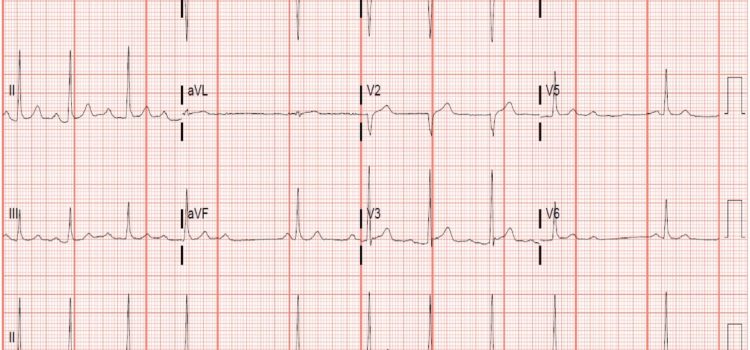 A 46-Year-Old Man with ‘Burning’ Epigastric Pain of Several Hours Duration