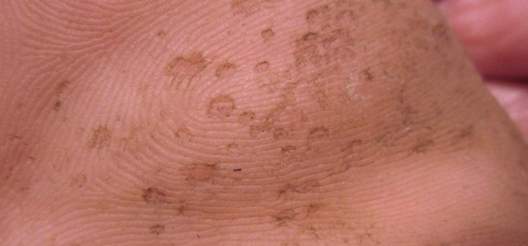 A 24-Year-Old Man with Excessively Odorous and Itchy feet