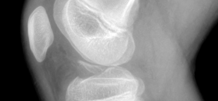 A 10-Year-Old Male with Knee Pain After a Football Game