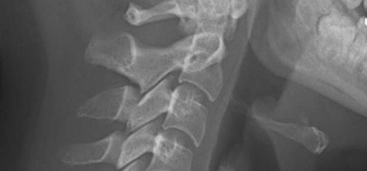 A 28-Year-Old Male with Fever and Difficulty Swallowing