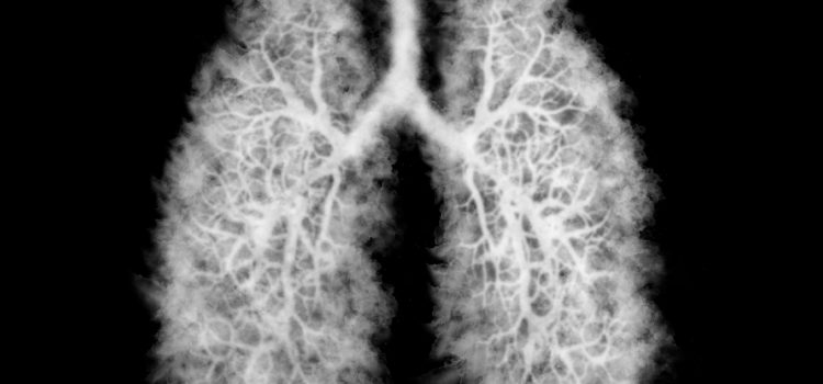 Vaping-Associated Lung Injury (EVALI) Presenting to Urgent Care Vaping-Associated Lung Injury (EVALI) Presenting to Urgent Care