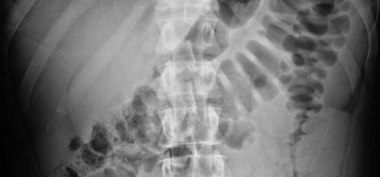 A 28-Year-Old Man with Diarrhea and Abdominal Pain